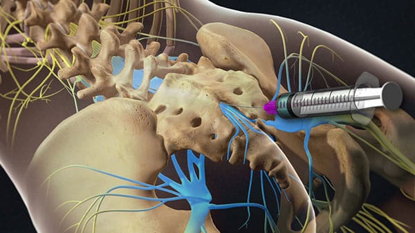 Caudal Epidural for back pain