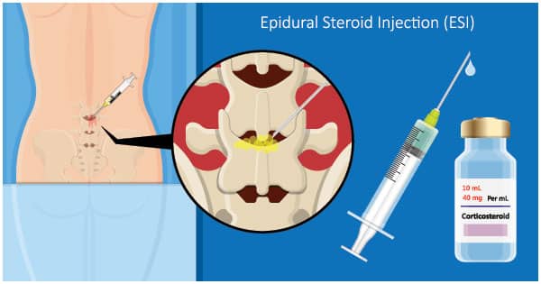 Epidural Steroid Injections