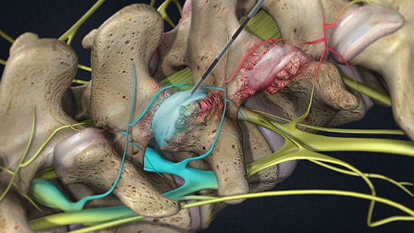 Cervical Facet Joint injection