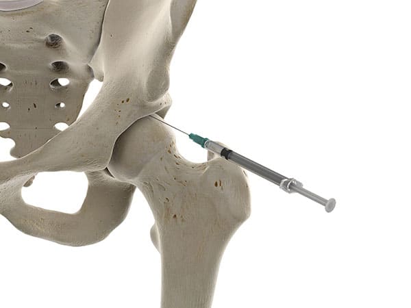 Hip injection for joint pain