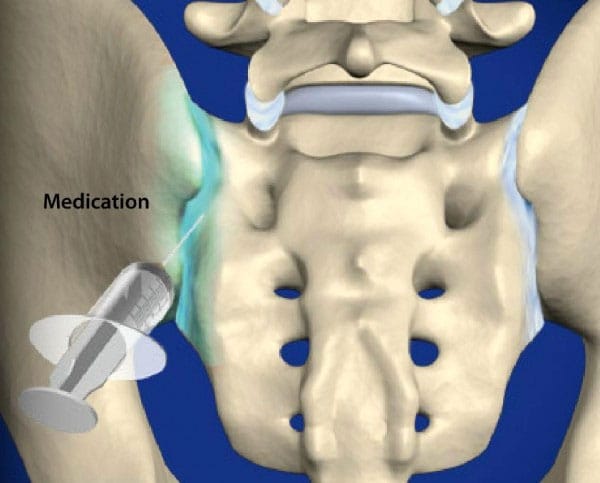 Sacroiliac Joint Injection