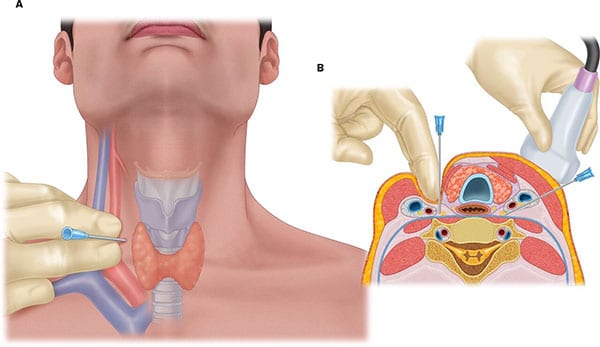 Stellate Ganglion Block