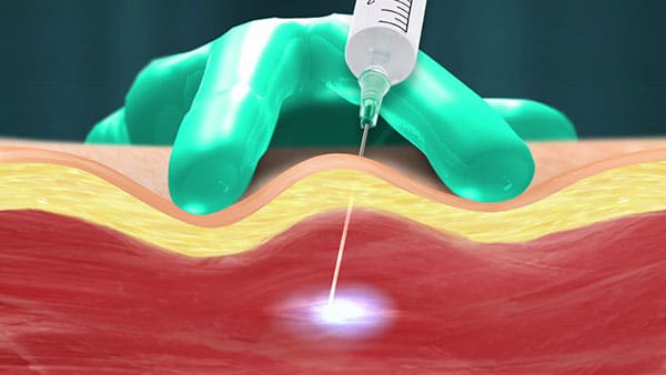 Trigger Point Injection