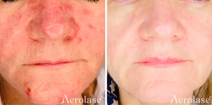 Rosacea treatment before and after with Aerolase Neo Elite