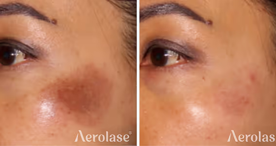 Vascular lesion treatment before and after with Aerolase
