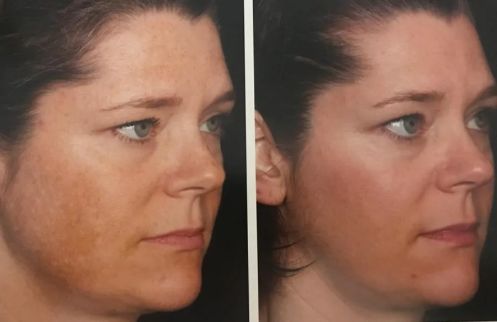 Chemical peel before and after results — skin texture improvement