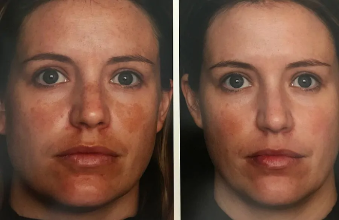 Chemical peel before and after results — skin tone evening