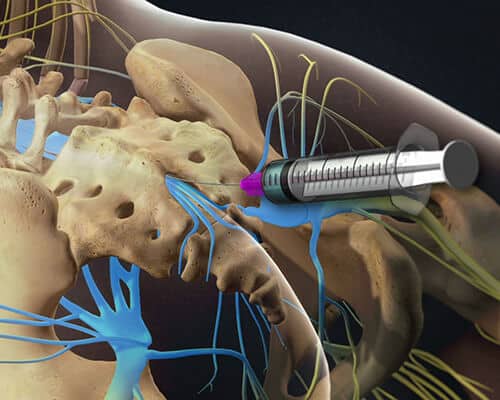 Pain management injections